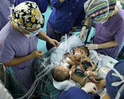 Successful Surgery Separates Conjoined Twins